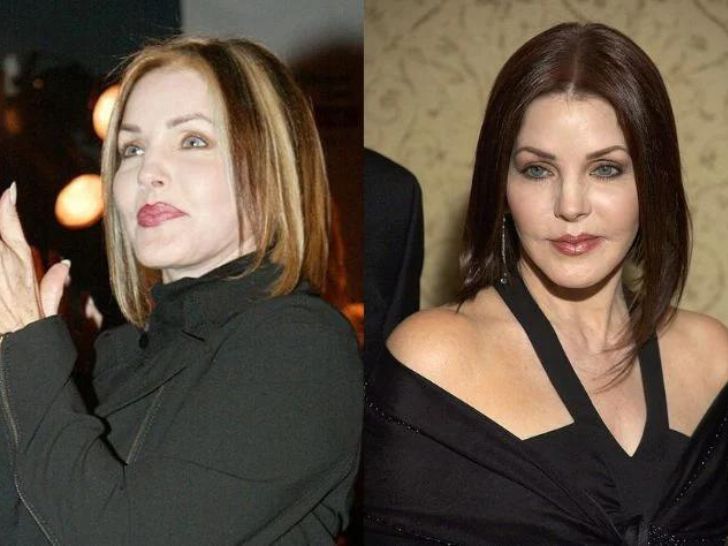 Side by side photos of Priscilla Presley before and after her botched injections.
