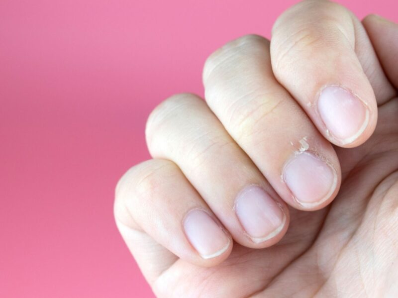 Fingernail with hangnail